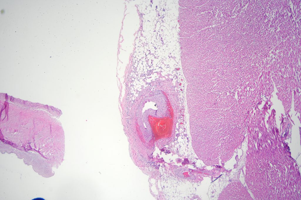 Coronary artery dissection